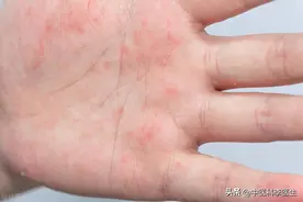手脚和身上动不动冒出“小水泡”？中医分析原因，拿出解决办法图片