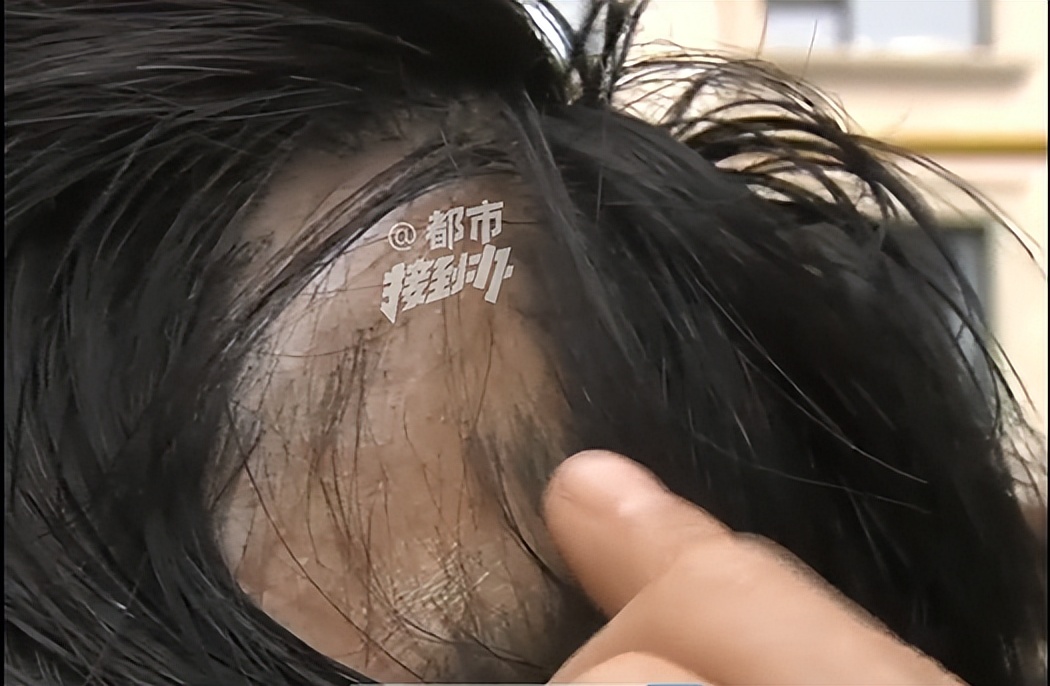 女子花3600给头皮打玻尿酸 头发大把脱落变斑秃、遭男友分手(图2)