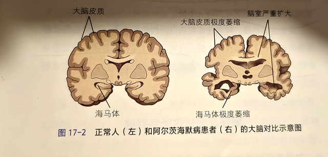 在人体实验中发现：酒喝得越多，脑容量越会变小，人就会越笨？