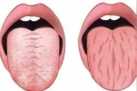 舌头中间有裂纹，两边有齿痕？中医有妙招恢复！图片