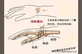 腱鞘囊肿，不花钱又简单的治疗方法：图片