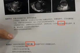 巧克力囊肿，直白讲就是一团瘀堵，用不着手术！图片