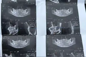 17岁女生实习时晕倒摔断4颗牙齿，8万多医疗费由谁承担？图片