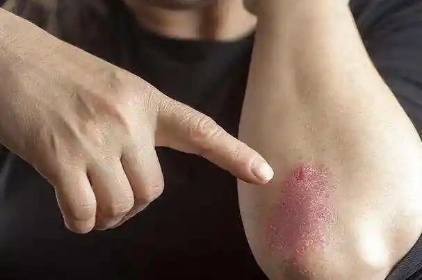 女人若是感染了“艾滋病”，胳膊上或有4种症状，都以为是皮肤病
