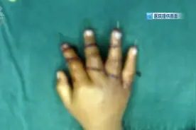 “担心接不上误了她一辈子”！一岁半宝宝4根手指被切成7段，目前情况→图片
