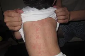 宝宝常见的10种皮疹，家长育儿必须收藏！图片