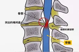 走路像脚踩棉花，是脑梗还是颈椎病？图片