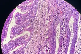 腺癌早期术后为啥不用化疗？医生用 3个理由说清楚图片