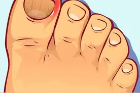 好痛！脚趾甲嵌进肉里怎么办？医生教你如何有效解决！图片