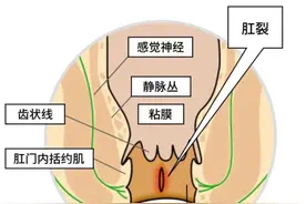 痔疮VS肛裂，你分得清吗？图片
