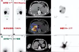 吉林省首例丨吉大一院成功开展钇-90树脂微球选择性内照射治疗（SIRT）肝癌项目图片