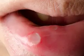 口腔溃疡患者饮食禁忌，营养专家提醒，远离刺激食物图片