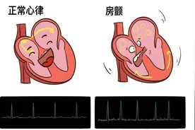 为什么房颤会引发心力衰竭？图片