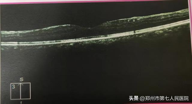 黄斑水肿如何消？专家这里有新招儿