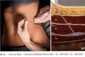 剖宫产术后镇痛新技术（TAP）：告别疼痛噩梦图片