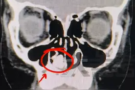 7岁男童鼻腔恶臭长达两年，“罪魁祸首”竟是一颗生锈螺丝钉图片