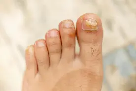 灰指甲要拔甲吗？口服药安全吗？治疗要点一次说清图片