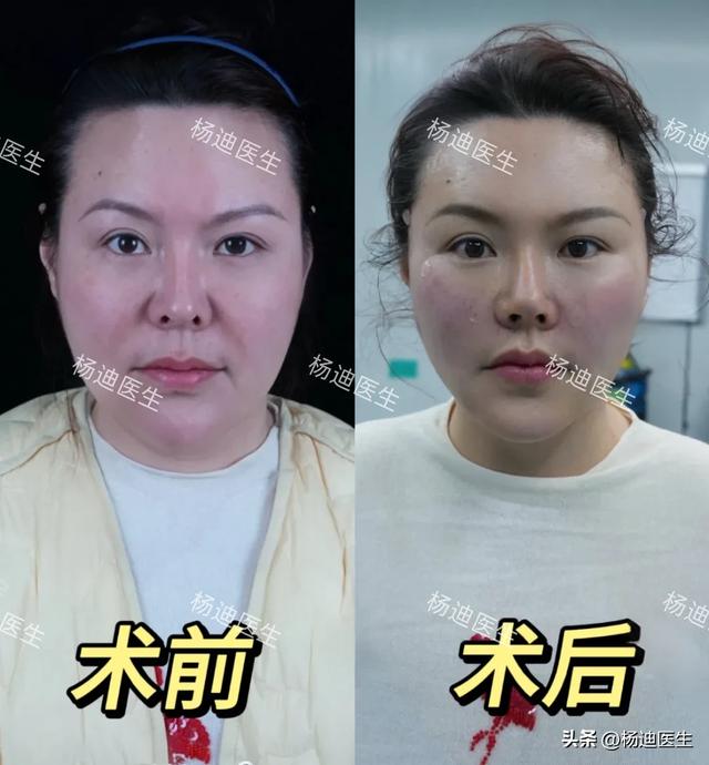 花4.5万做面部提升，闺蜜却说“整容脸”！真的有那么假吗？