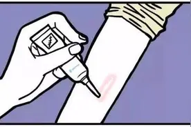 为什么疤痕增生医生都推荐激光治疗？真的有那么好吗？图片