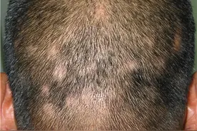 梅毒皮肤病的伪装大师图片