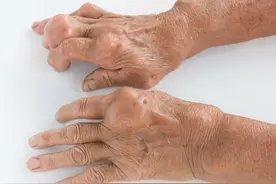 尿酸高引起的痛风石，如果尿酸正常了，痛风石会自己消除吗？图片