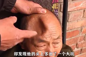 河南老人住养老院仅20天，头顶凹个大坑脑出血，养老院：与我无关图片