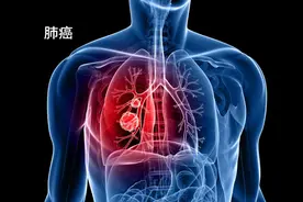 肺癌多是“拖”出来的，提醒：身体有这3个表现，千万别轻易忽视图片