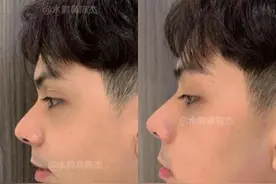 男生下巴后缩：下巴后缩严重如何改善？图片