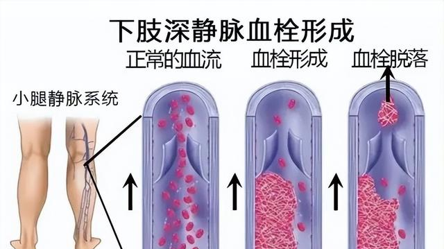 马上停止7类运动，很可能加速血栓形成！等血管“堵死”就迟了