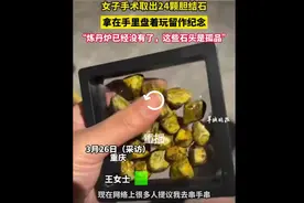 太奇葩了！女子手术取的20多颗胆结石，拿在手里把玩！图片