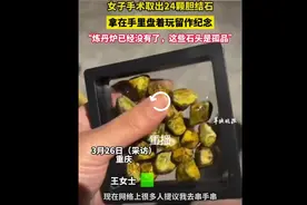 太奇葩了！女子手术取的20多颗胆结石，拿在手里把玩！图片