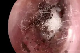 暴力采耳致耳道“发霉长毛”，医生：耳朵有自洁功能，没必要经常清理图片