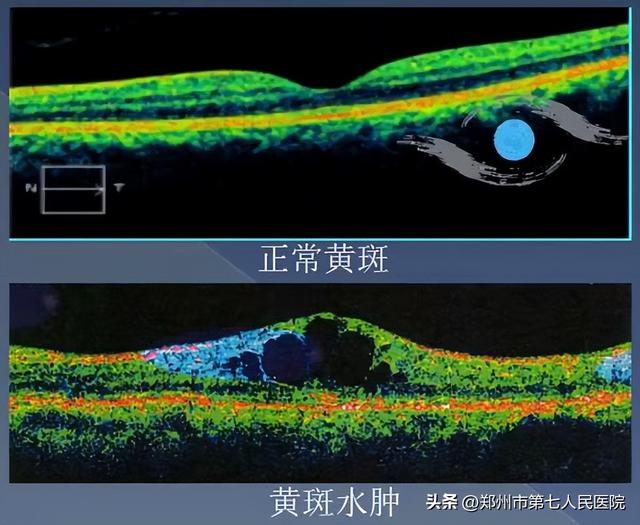 黄斑水肿如何消？专家这里有新招儿