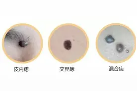 了解皮肤色素痣：成因、种类和治疗方法图片