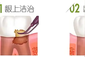 牙周病一定要深刮吗？到底刮什么？图片