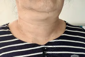 宁德女子脖子变粗20多年，以为是“长胖了”，原是这种肿瘤作祟图片