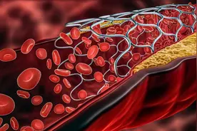 心脏支架3年，再次出现堵塞，4个原因没有重视，给您解决办法图片