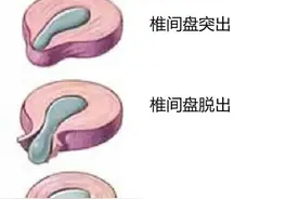 腰椎间盘膨出、突出、脱出、游离有什么区别?哪个最难治？图片