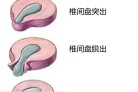 腰椎间盘膨出、突出、脱出、游离有什么区别?哪个最难治？图片