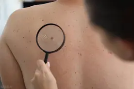 八处有痣是富贵痣，哪里长痣最有福气？图片