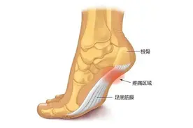 经常脚后跟疼别大意，或与4种疾病有关！小心久拖不治变“废”人图片