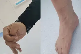 41岁男子偏瘫四年 创新结合手术重燃希望图片