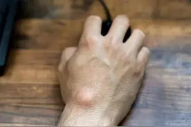 发现脂肪瘤，只知做手术的人太傻了！重用一味药，瘤块消得快图片
