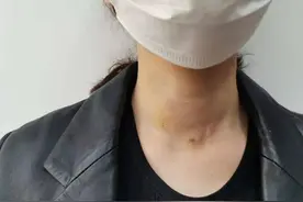 桥本病，不宜长期吃4种食物，或会刺激抗体升高，好多朋友不知道图片