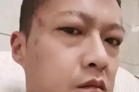 “槟榔四巨头”：狂炫槟榔，二年三人逝去，最后一人割舌逃过一劫图片