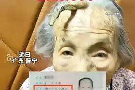 百岁老人额头长“角”，网友评论“这是长寿角，长寿的象征”！图片