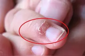 “倒欠”是啥？手上的小恶魔其实是自我修复的警告！图片