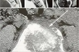 脊椎嗜酸性肉芽肿图片