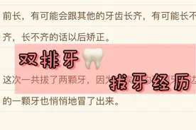 双排牙，拔牙经历~ 小记录图片