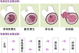 乳腺结节分级：全面解析与应对指南图片